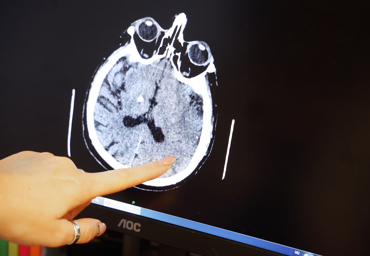 Szeged, fiatalkori sztrók, sztrók, Szabó Nikoletta, neurológus, egészségügy