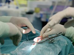 Szeged, okos cochleáris implantátum beültetés, műtét, Szegedi Tudományegyetem, SZTE, Fül- Orr- Gégészeti és Fej- Nyaksebészeti Klinik, hallókészülék, műtő, klinika, egészségügy